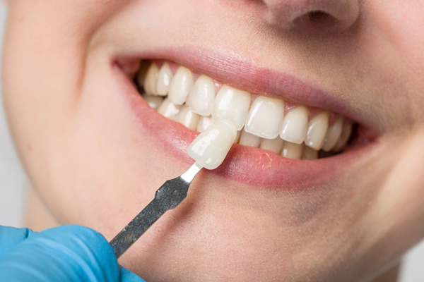 Frau bekommt Veneers eingesetzt