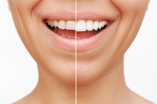 Ästhetischer Vergleich mit Veneers vorher/nachher