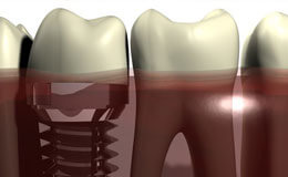 Zahnimplantate der Implantologie